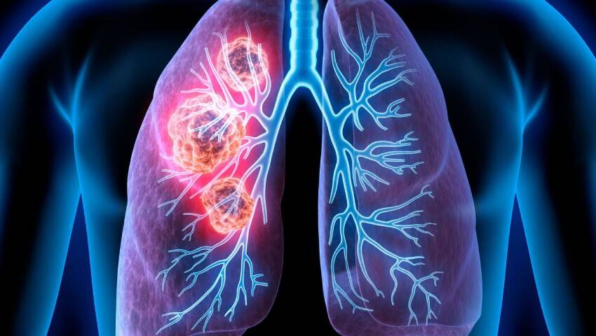 Lung Cancer Blog