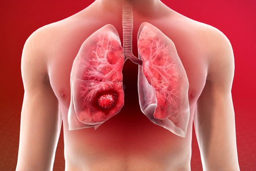 Lung Cancer