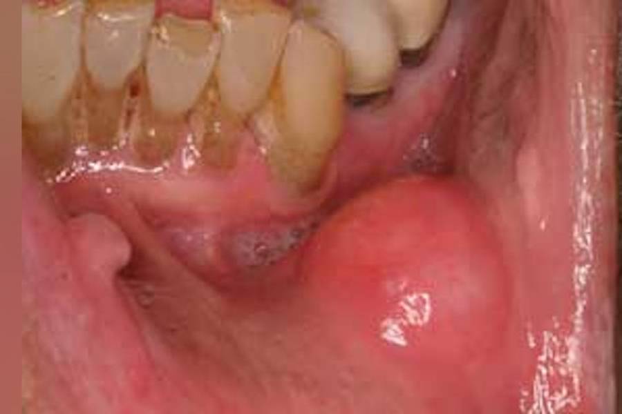 Oral Cancer