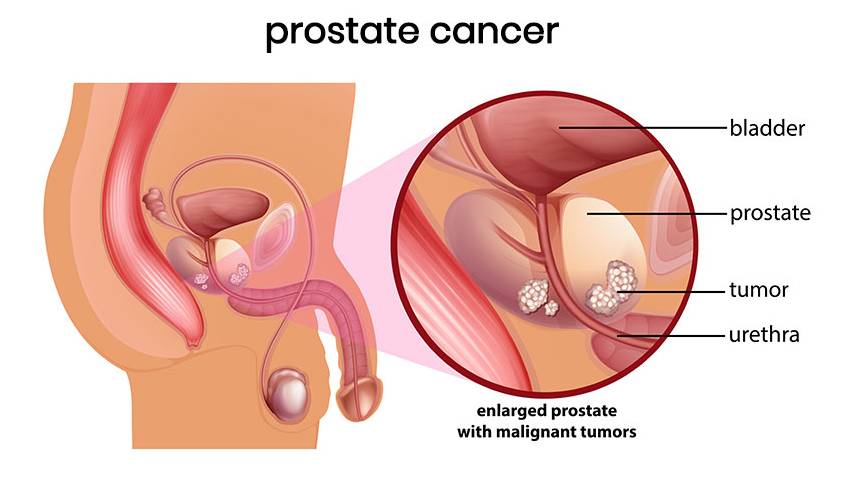 Pre-Symptoms of Prostate Cancer