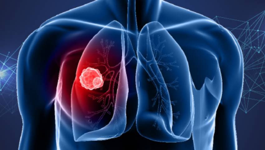 Lung Cancer Screening Who Should Get Tested and Why