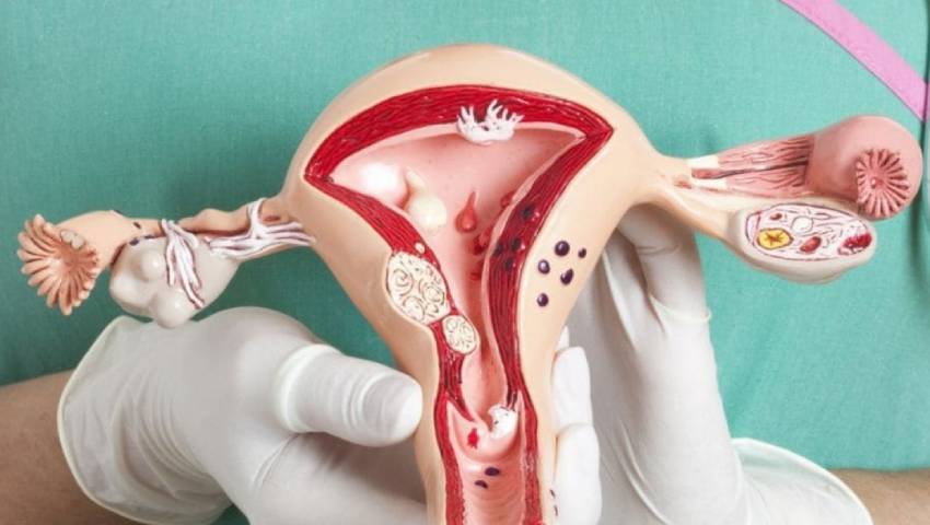 Cervical Cancer What Every Woman Must Know About Risks Prevention