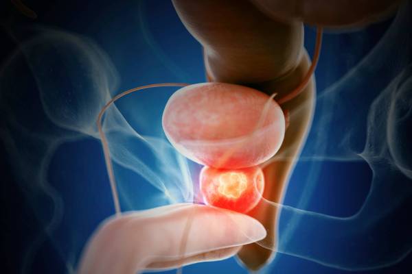 Prostate Cancer Treatment