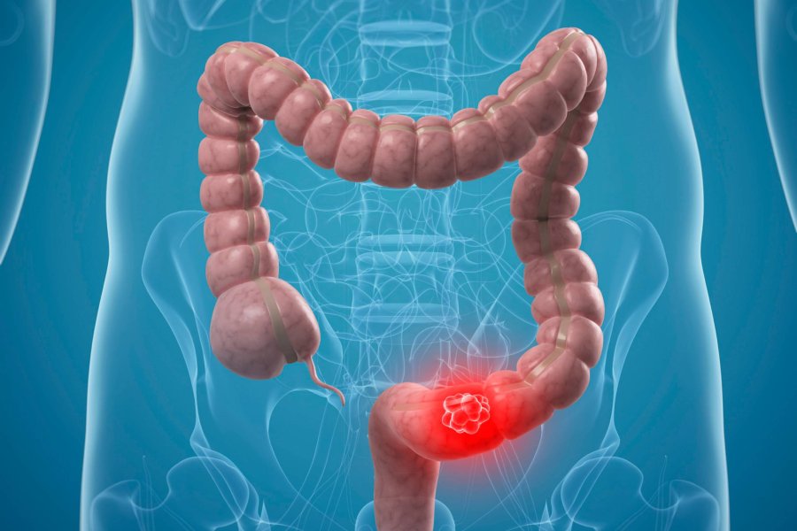 Colon and Stomach Cancer Treatment