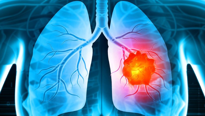 Can Lung Cancer Be Cured If Caught Early
