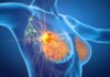 Giredestrant Improves PFS in ER HER2– Breast Cancer