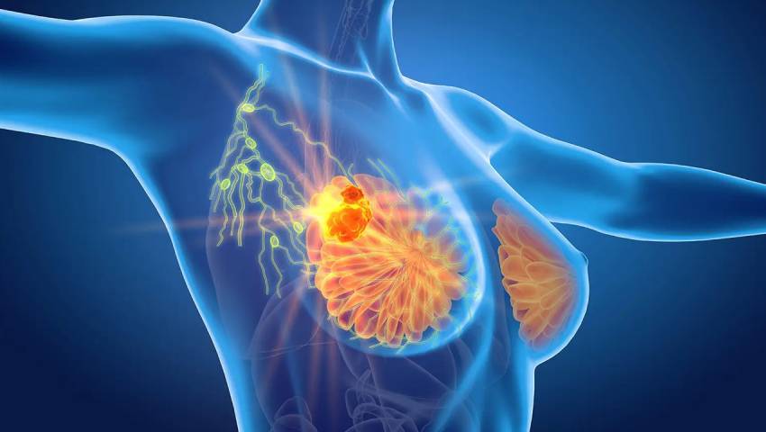 Giredestrant Improves PFS in ER HER2– Breast Cancer