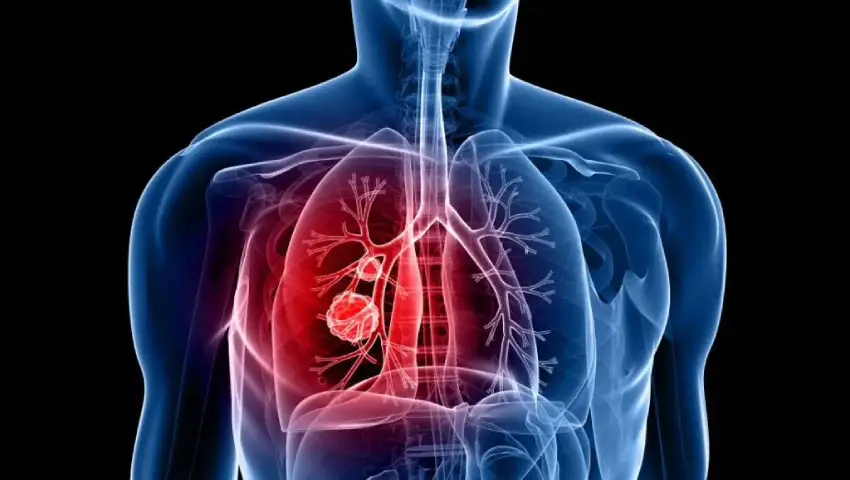 Lung Cancer Treatment