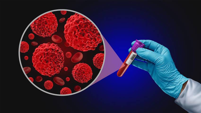 Liquid Biopsy A Simple Blood Test for Early Cancer Detection
