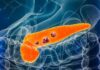 Illustration showing tumors in the pancreas – representing early warning signs of pancreatic cancer.