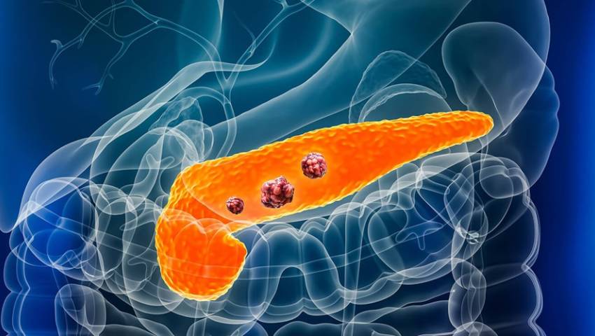 5 Early Warning Signs of Pancreatic Cancer You Shouldnt Ignore