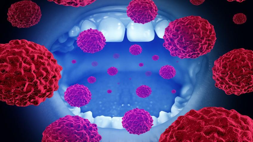 Is Immunotherapy Effective for Stage 4 Mouth Cancer