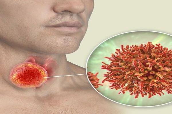 Anaplastic Thyroid Cancer