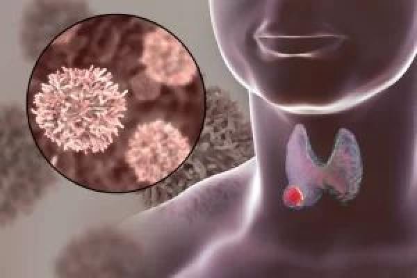 Follicular Thyroid Cancer