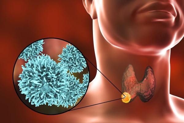 Papillary Thyroid Cancer